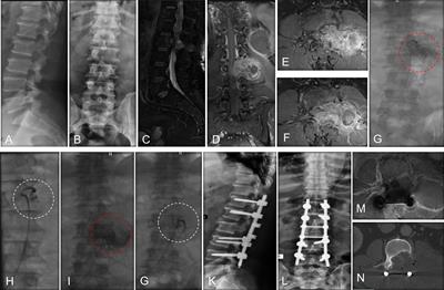 Preoperative embolization in the treatment of patients with metastatic epidural spinal cord compression: A retrospective analysis